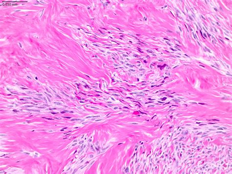 Ovarian Fibroma Histology