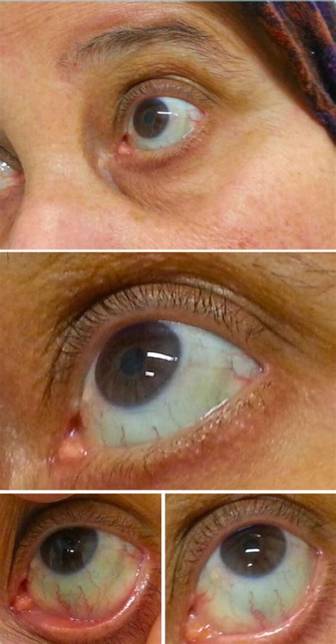 Blue sclera causes, symptoms, diagnosis, treatment & prognosis