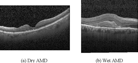 Macular Degeneration Oct