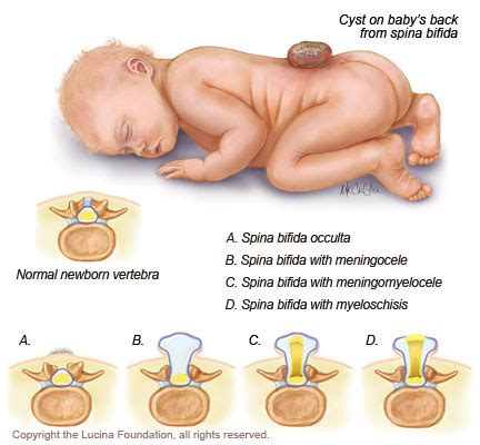 Punca Dan Risiko Anemia Ketika Hamil