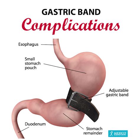 Gastric Banding (Lap-Band) Surgery Risks, Complications
