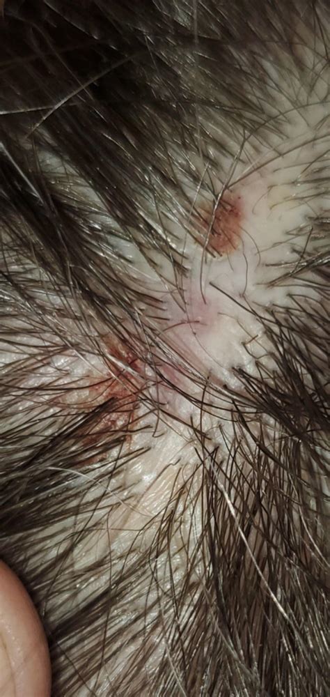 Red Bumps On Scalp Reviewing Root Causes Holistic Tre - vrogue.co