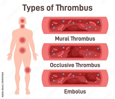 Thrombus types. Arteriosclerosis, infarct, ischemia, thrombosis disease ...