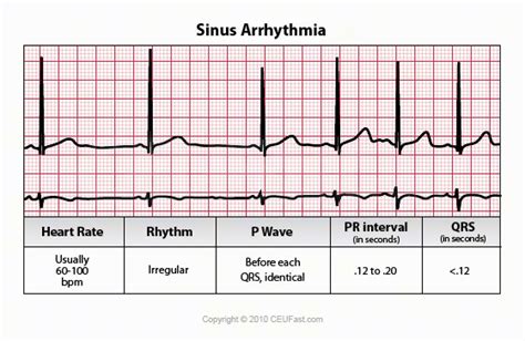 EKG, ECG Interpretation Course | CEUfast Nursing Continuing Education