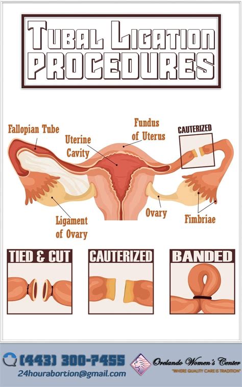 Pregnancy After Tubal Removal - Reproduction Online