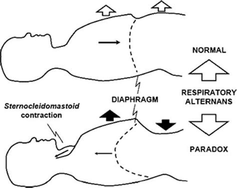 Paradoxical breathing (abdominal paradox): Mechanism | Medicine Specifics