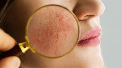 Broken Capillaries On Face: Causes, Results, And Solutions - Doctor Mier