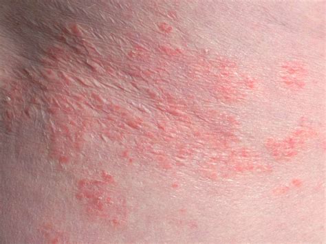 Inverse psoriasis vs. intertrigo: Symptoms, causes, and identification