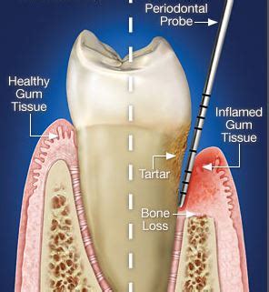 Periodontal Scaling and Root Planing | SRP SRPs | Pasadena TX