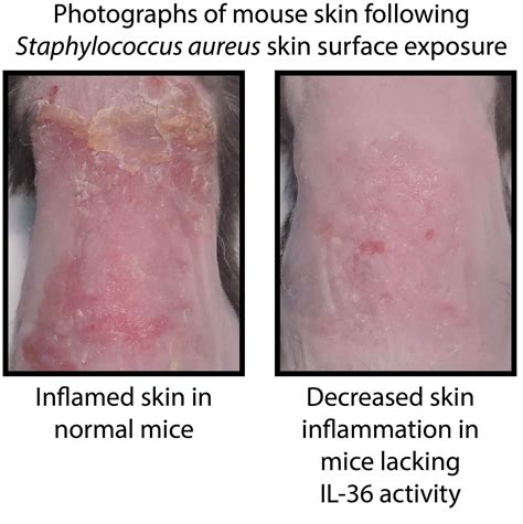 How the Skin Becomes Inflamed - 11/08/2017