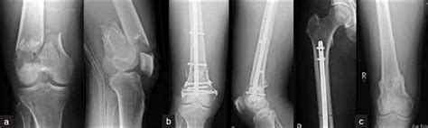 Distal Femur Fracture Classification