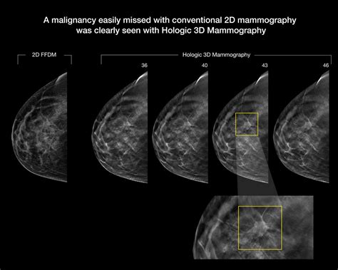 3D Mammography Improves Cancer Detection in Dense Breasts - OGP News