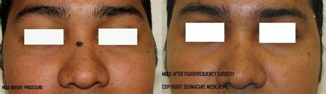 Manhattan, New York MOLE/ SKIN TAG removal with radiosurgery or laser