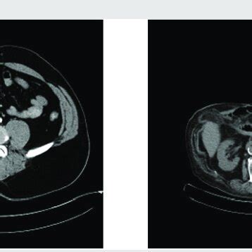 Two cases with colocutaneous fistula. | Download Scientific Diagram