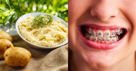 9 Best Soft Foods For New Braces