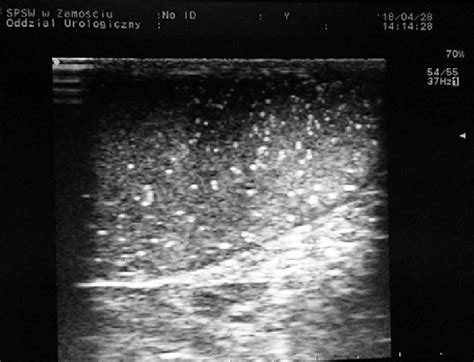 Ultrasonographic image of testicular microlithiasis (28-year-old ...