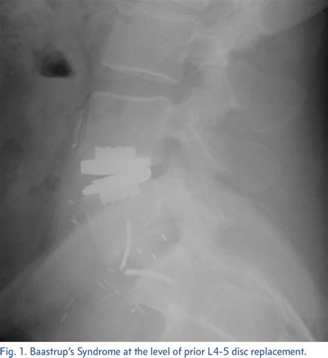 Figure 1 from Following Anterior Interbody Lumbar Spinal Surgery Iatrogenic Baastrup ' s ...