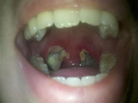 Tonsillectomy Recovery Photo Day 5 – Tonsillectomy