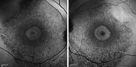 Bull's eye maculopathy - American Academy of Ophthalmology