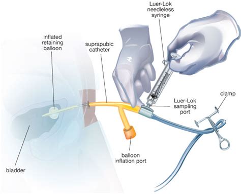 Suprapubic Catheter Diagram