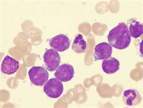 Medical Pictures Info – Acute Lymphoblastic Leukemia