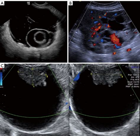 Pelvic Ultrasound Ovarian Cancer