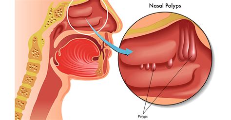 Nasal Polyps - Alabama Nasal and Sinus Center, Birmingham, AL, ENT