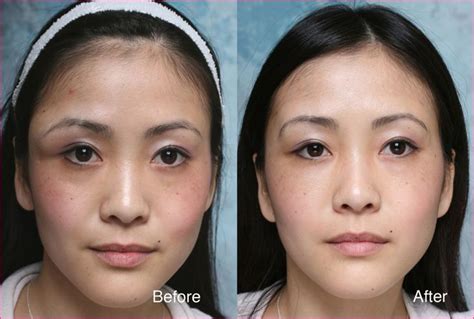 Dr Kim plastic surgery cost - Plastic Surgery Celebrity #plasticsurgery ...