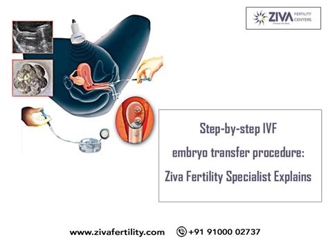 Step-by-step IVF embryo transfer procedure: Ziva Fertility Specialist ...