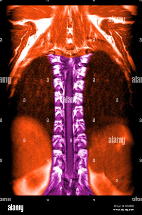 Mri of normal thoracic spinal cord hi-res stock photography and images - Alamy