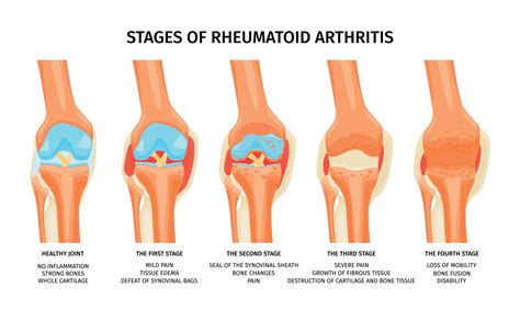 Rheumatoid Arthritis Stages Infographics 21855607 Vector Art at Vecteezy