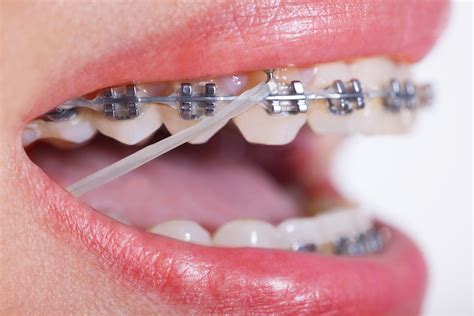 Rubber Bands Braces 101 - Orthodontics Limited