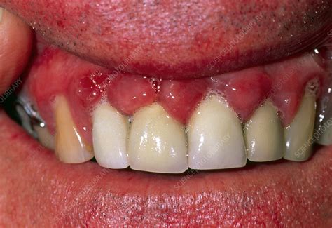 Hyperplasia of the gums due to the drug nifedipine - Stock Image - M170/0228 - Science Photo Library