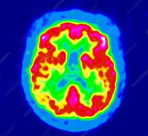 Alzheimer's disease, PET scan - Stock Image - C021/5462 - Science Photo ...