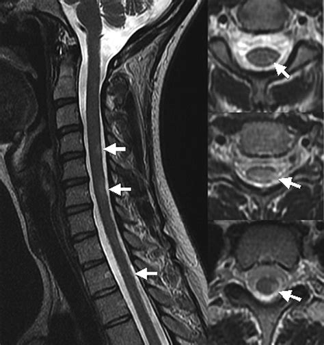 Neuroimaging in Acute Transverse Myelitis | Radiology Key