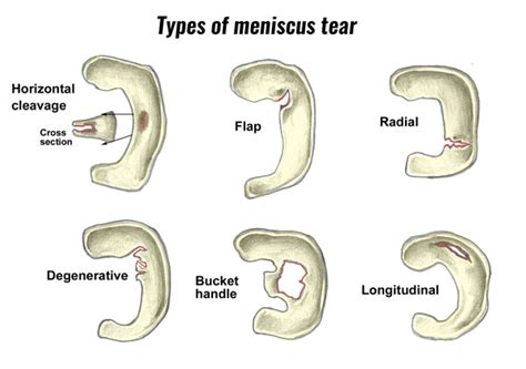 Meniscus Tear — Huang Orthopaedics