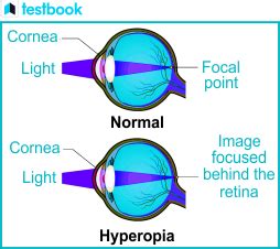 Hyperopia - Causes, Symptoms, and Correction Methods