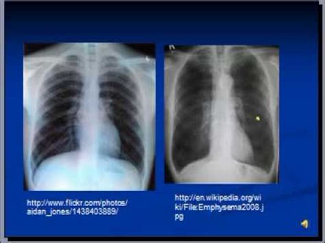 Emphysema on emaze