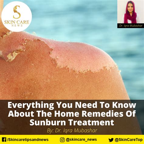 Everything you need to know about home remedies of Sunburn