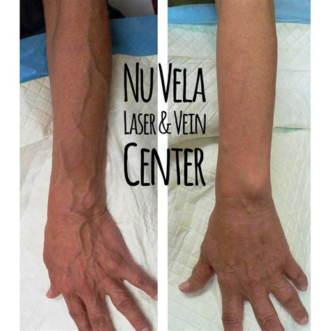 #handveintreatment and @handveinremoval with #Sclerotherapy by Dr. Raffi Dishakjian at his # ...