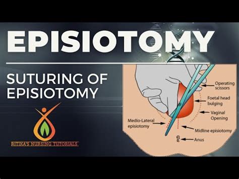 Episiotomy || Types|| Articles || Procedure @ritikasnursingtutorials ...