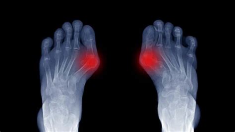 Arthritis in Big Toe: Learn how to identify and treat Hallix Rigidus