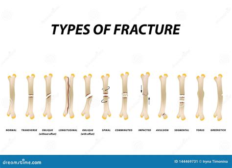 Types De Fractures