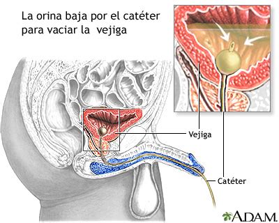 Cateterización de la vejiga en el hombre: MedlinePlus enciclopedia médica illustración