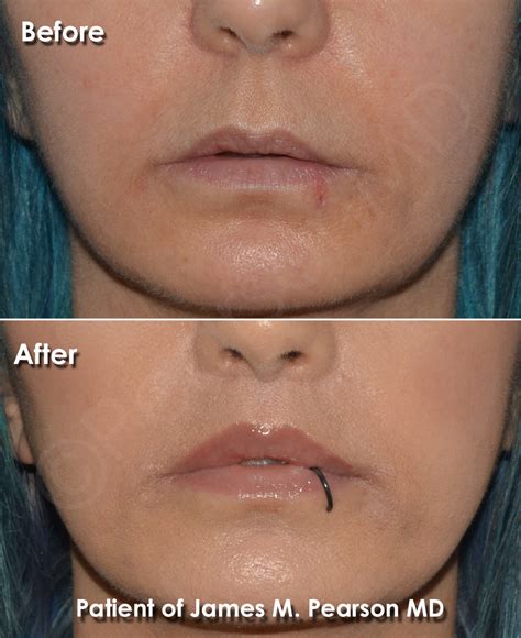 Lip Lift Photos - Before & After - Dr. James Pearson Facial Plastic Surgery