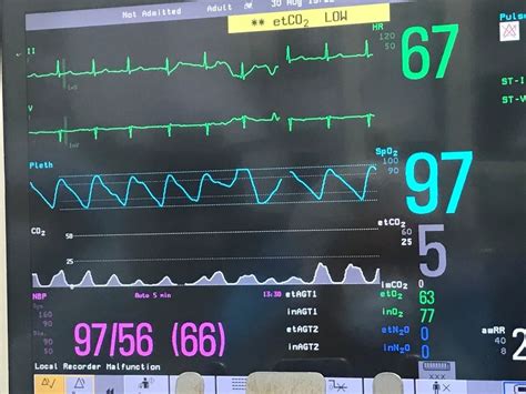 A Systematic Approach to Capnography Waveforms - JEMS: EMS, Emergency Medical Services ...