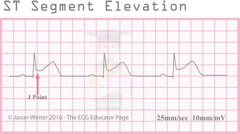 ECG Educator Blog : ST Segment Elevation Morphologies