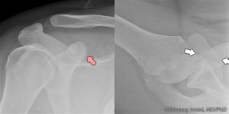 Roentgen Ray Reader: Coracoid Fractures