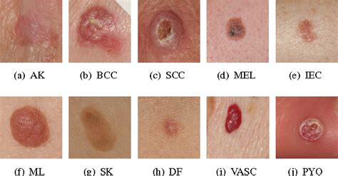 Identifying Skin Lesions