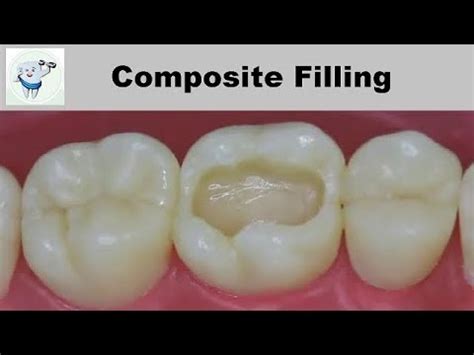 Composite Dental Filling Step by Step - YouTube